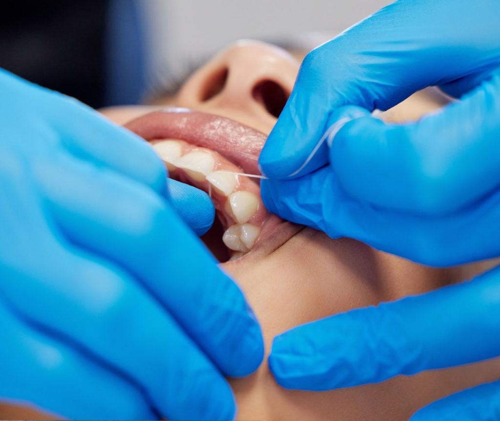 Chipped tooth repair