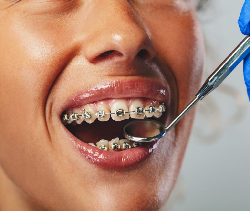 Clear Aligners Overview