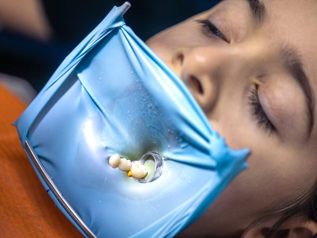 Dental Bridges