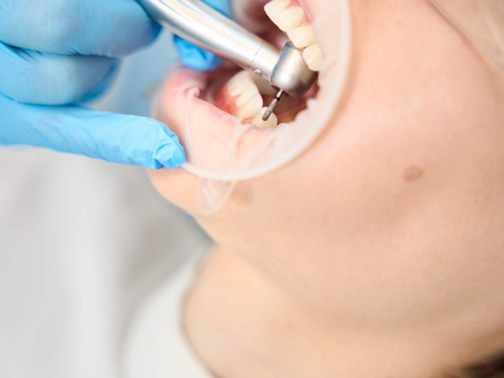 Dental Filling