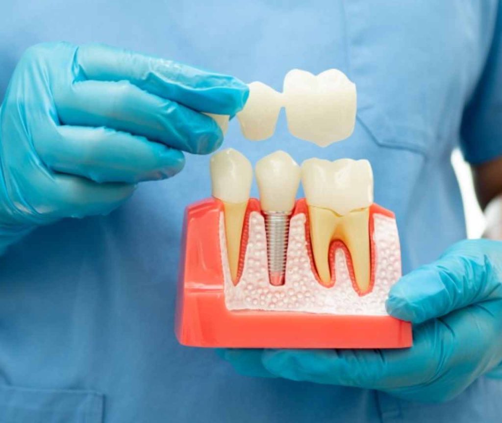 High Quality Crowns with Precise Fit