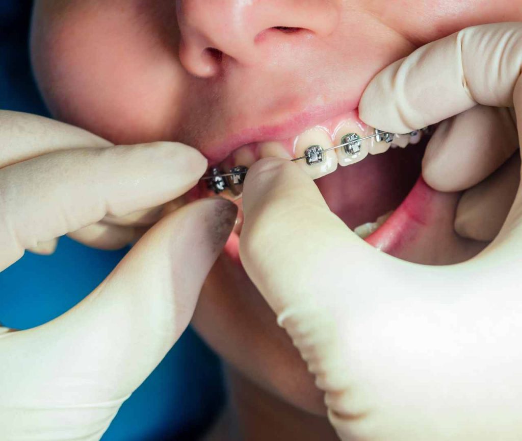 Orthodontics treatment