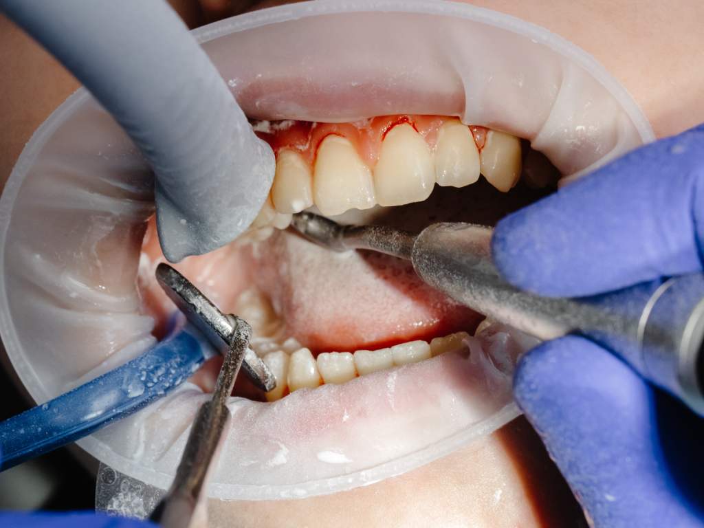 Periodontal Maintenance