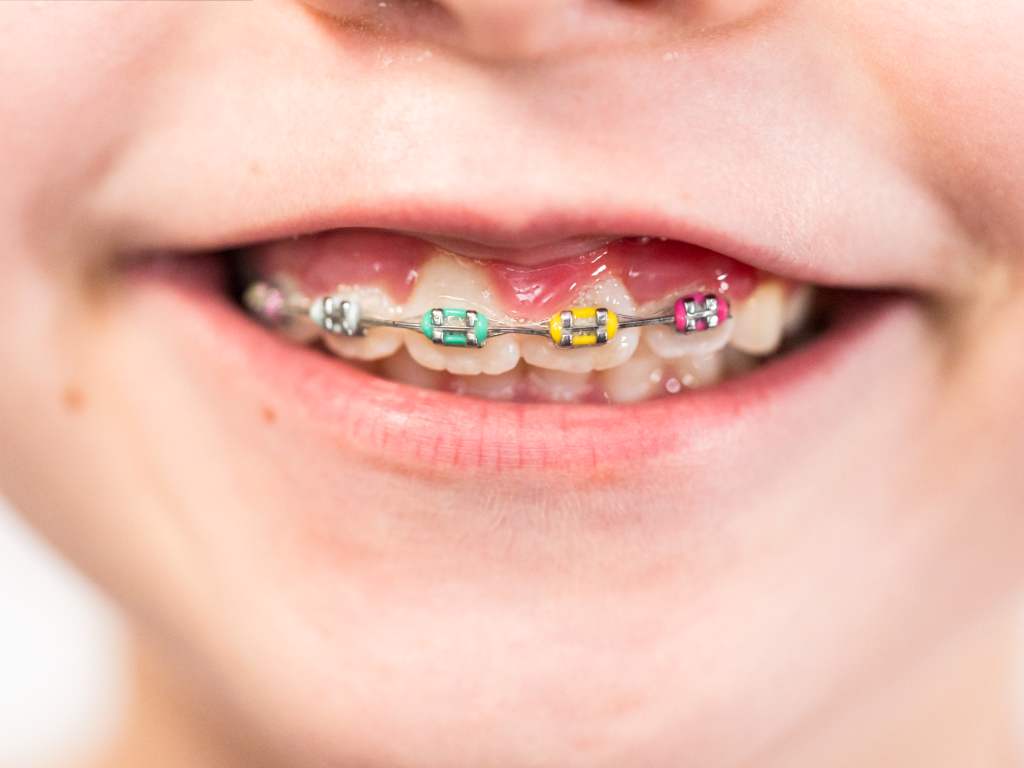 Braces