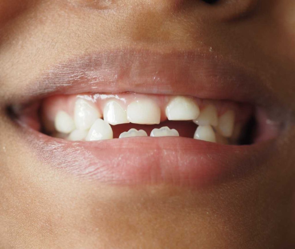 chipped tooth
