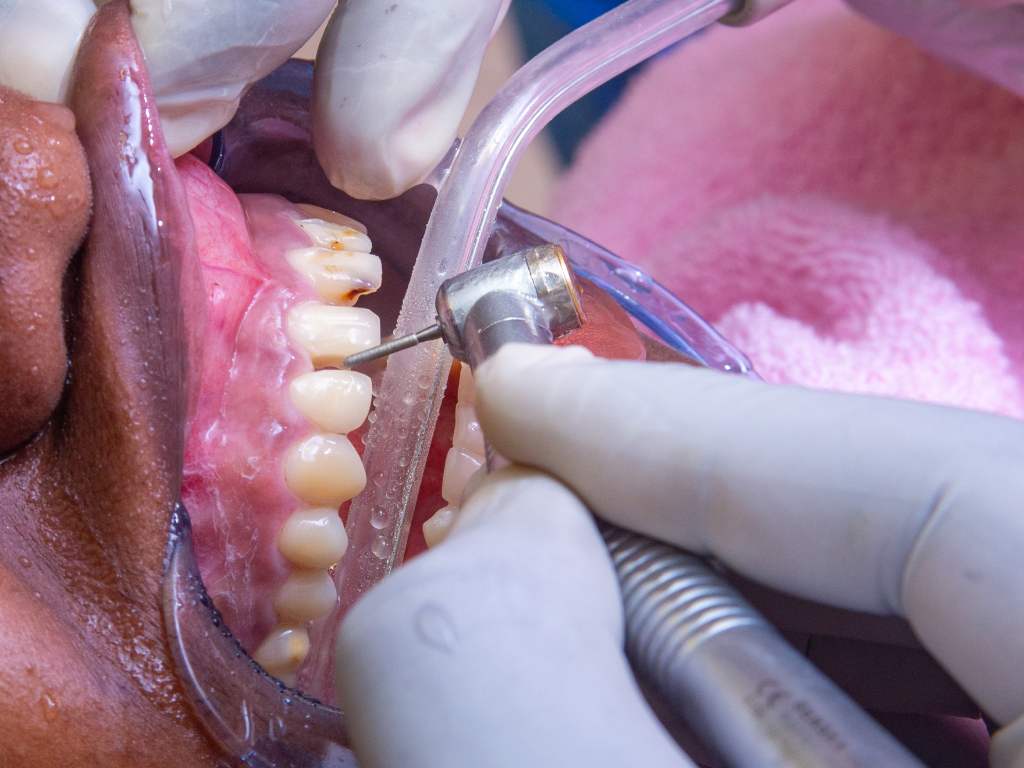 gum diseases