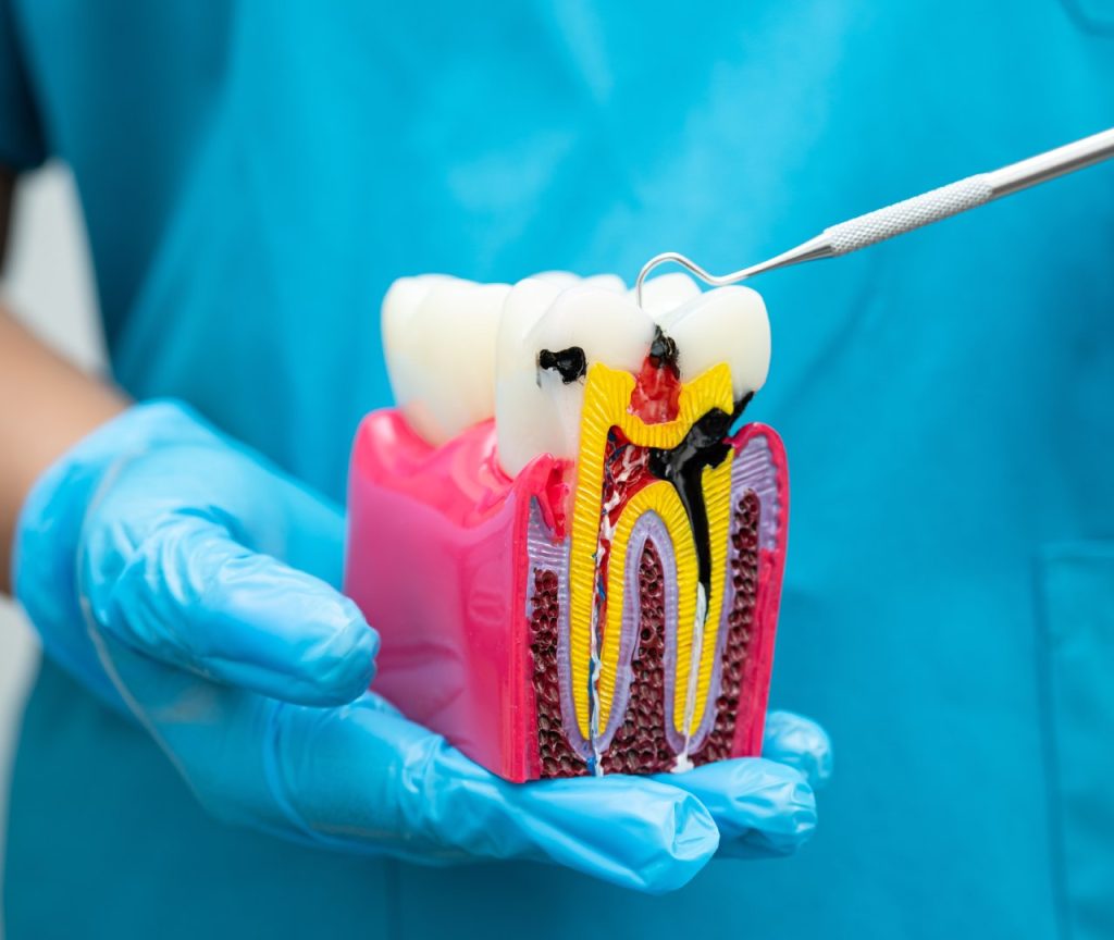 infected tooth model