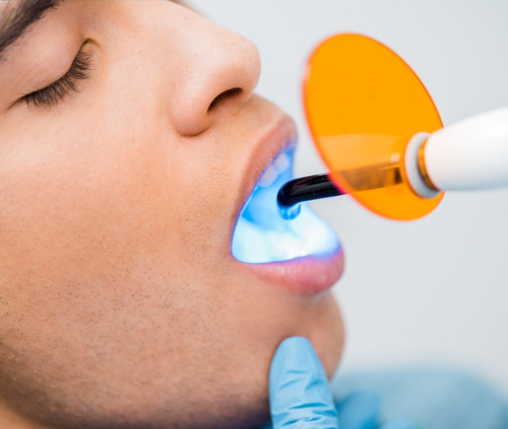 teeth whitening process